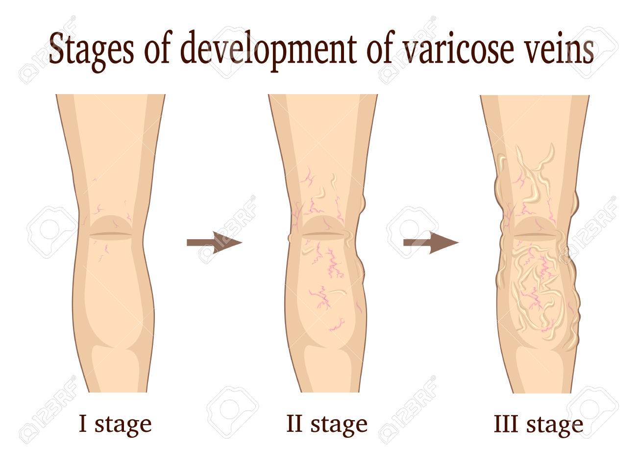 Варикоз Первые Симптомы