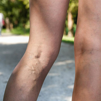 Swollen legs, edema