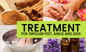 Treatment for swollen feet and legs.