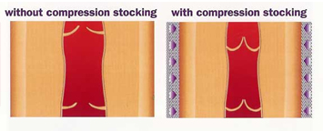 difference between pressure applied and swelled legs