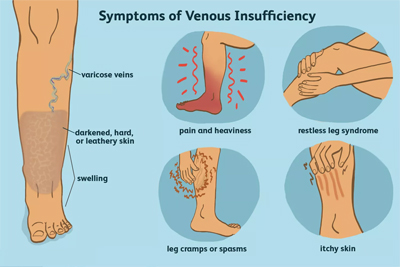 symptoms of venous insufficiency, chronic venous diseases