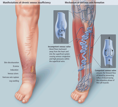 different medical conditions of foot like edema, varicose veins