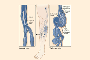 picture-of-two-feet-one-with-normal-veins-other-with-varicose-vein