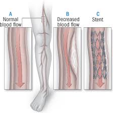 Normal Blood flow vs Decreased Blood Flow