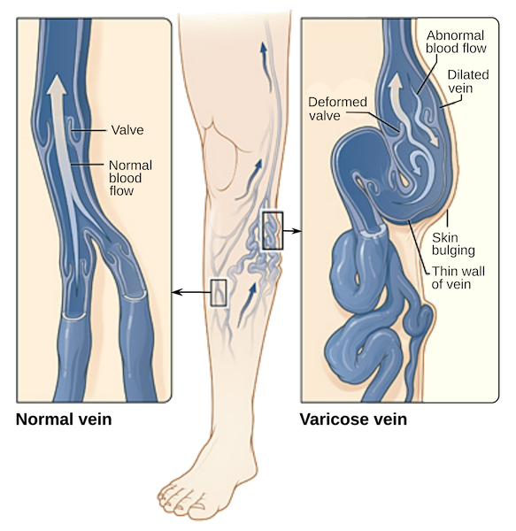 Diagram of Normal vein vs Varicose vein