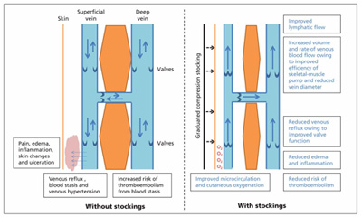 picture showing effects of graduated compression stockings on veins, blood flow increased,