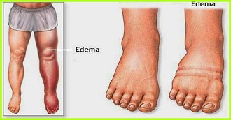 demonstration of idiopathic edema