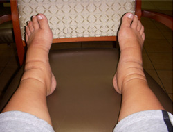 picture of a swollen feet elevated on a chair