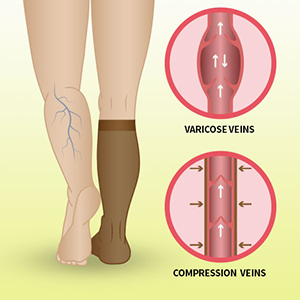 An image showing action of compression stockings on the leg versus a leg without the socks
