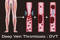 demonstration of deep vein thrombosis