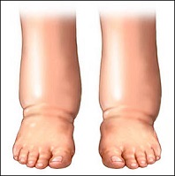 picture of men with edema