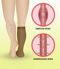 illustration showing feet with varicose veins and feet with compression socks on, spider veins in nurse feet 