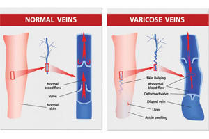 illustrated picture showing difference between normal veins and varicose veins