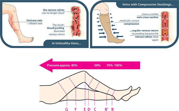 Side Effects Of Wearing Compression Stockings