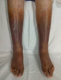 Various diseases of legs