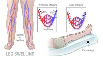 picture showing swelling in legs