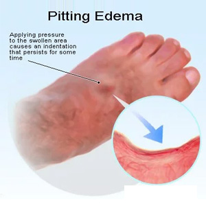 effects of simple finger test by applying pressure on the area
