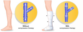 illustrated picture showing comparison of leg with and without compression therapy