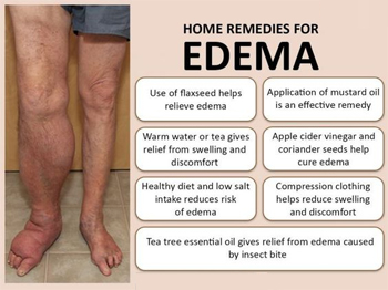 Home Remedies for Edema