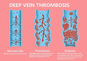  An illustration of an embolus formation to grasp the need for anti-clot stockings