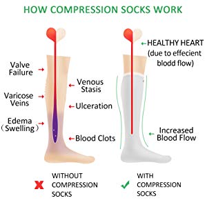  An illustration of how maternity compression knee-high socks eliminate edema