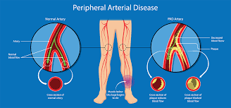 Arterial disease