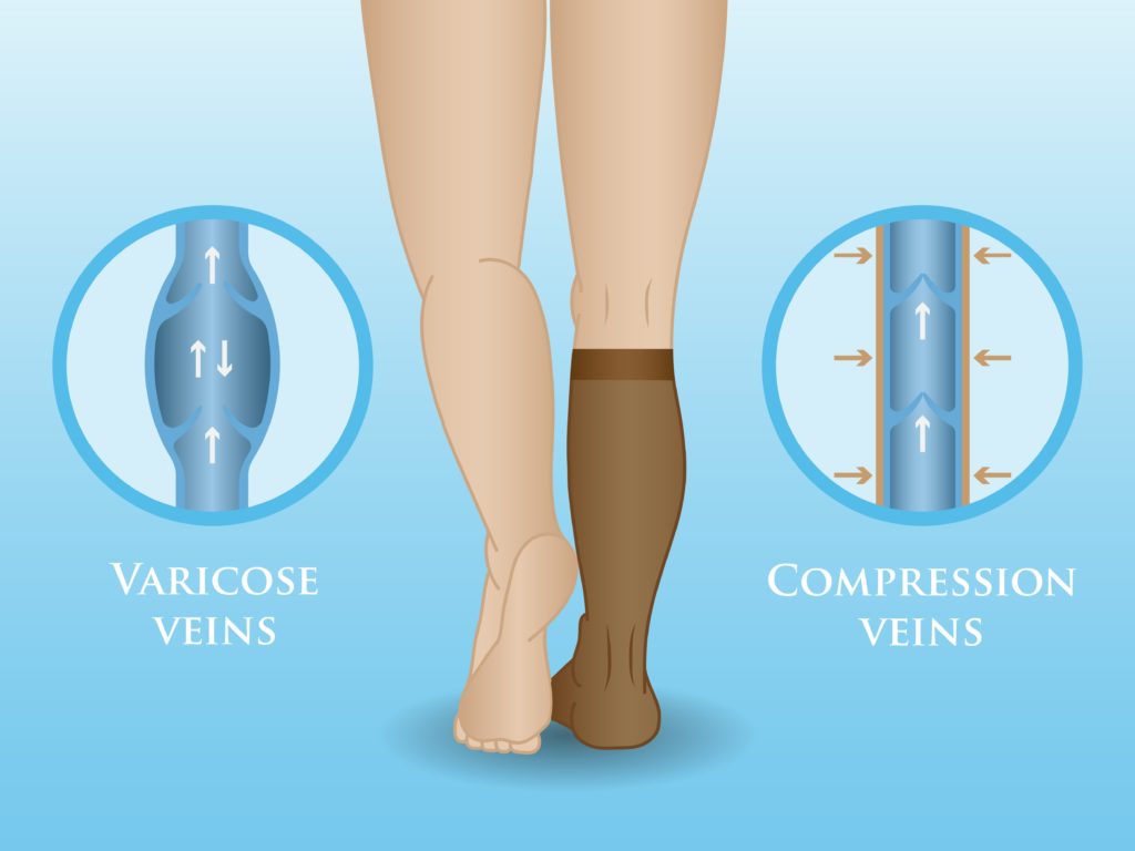 Usefulness of Compression Socks