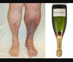 Champagne bottle legs