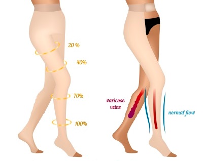 How do Women Compression Hose Work for varicose veins