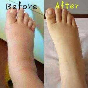 Before and after shot of a foot that reduced its swelling