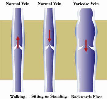 Venous reflux is a very common and important disease.