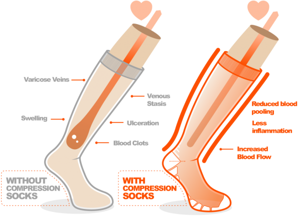 how-long-to-wear-compression-socks-for-edema-swelling