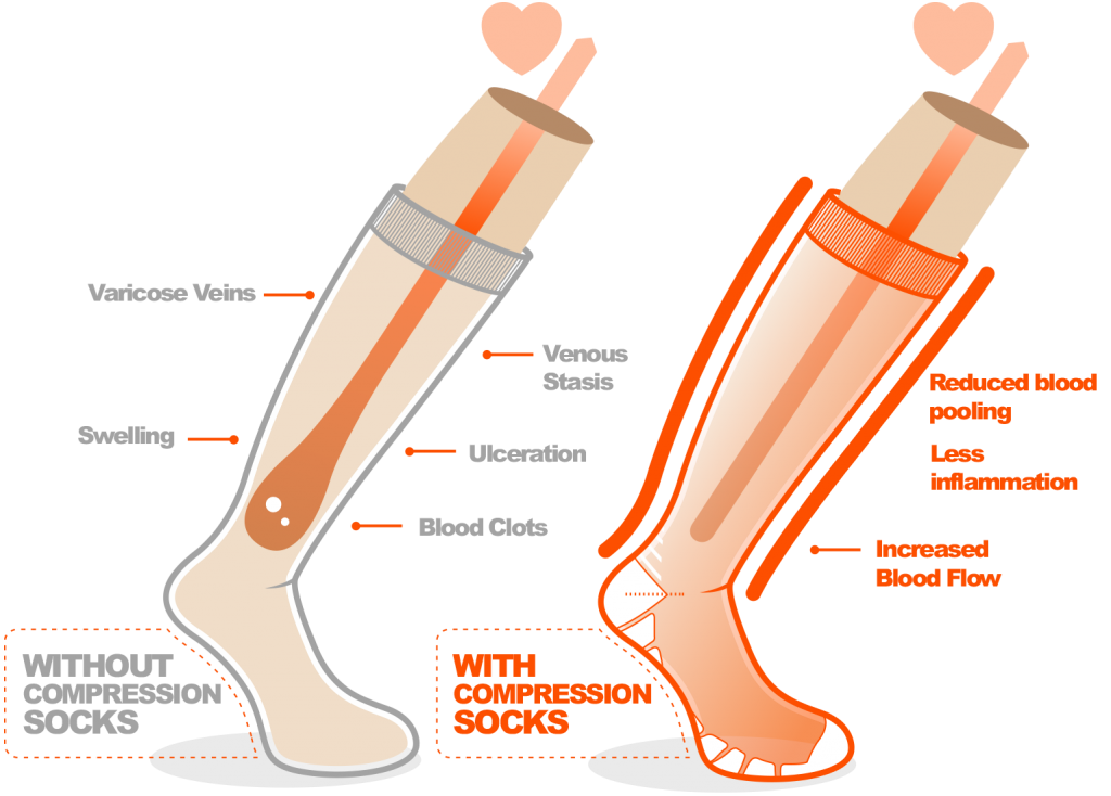 How Long to Wear Compression Socks for Edema (Swelling)