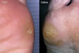 Corns and calluses