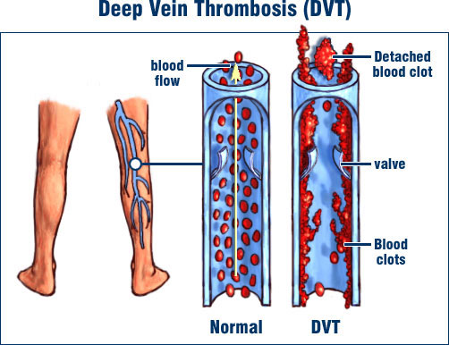 Graphic of Deep Vein Thrombosis