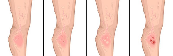 Stages of Deep Vein Thrombosis