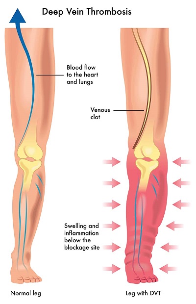 Deep Vein Thrombosis