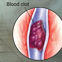 blood clot due to DVT