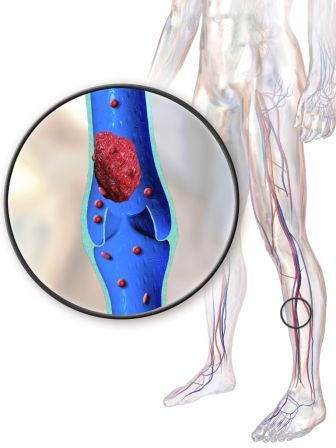 DVT can be prevented with 20-30mmHG compression socks