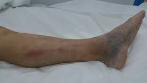 DVT causes skin discoloration