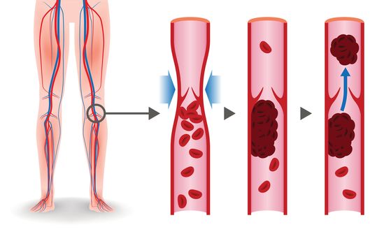Deep Vein Thrombosis issues