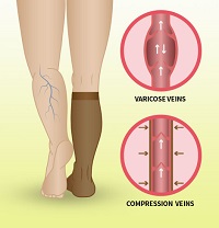  An image of how compression socks prevent the development of varicose veins