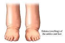 Edema 