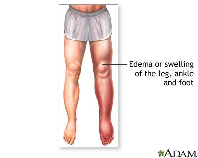 Edema Leading to Swelling of Leg, Ankle and Foot in Men