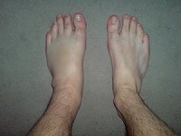 Edema in the leg - Swollen Foot