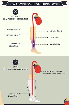 How compression stocking works