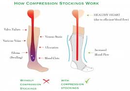 Swollen feet with compression stocking