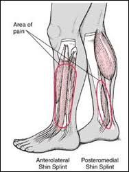 Compression socks vs compression sleeves