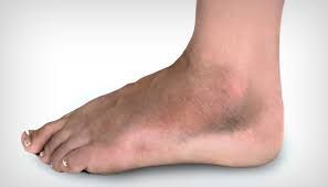 Kidney Problems Cause Swollen Ankles and Legs