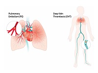  An illustration of clots in the capillaries of the lungs to raise awareness of anti-clot stockings